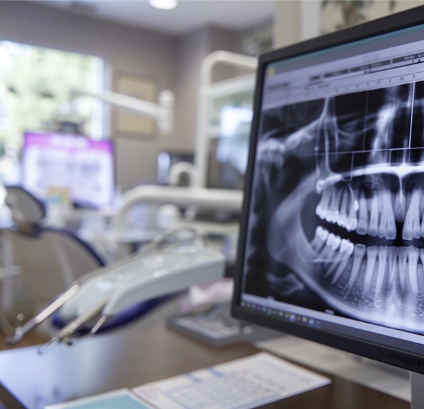 Implantes Dentales