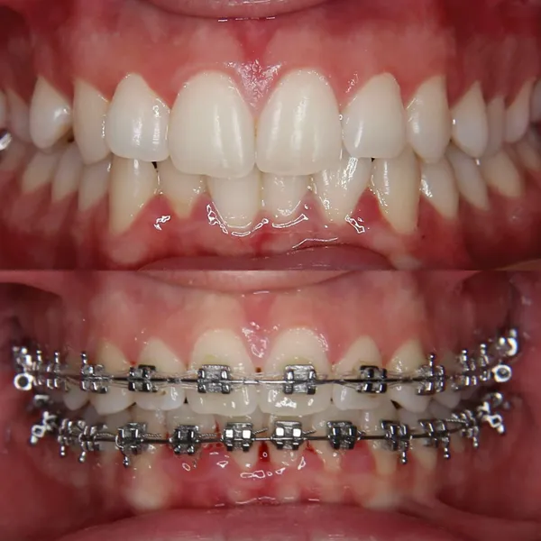 Ortodoncia con Brackets